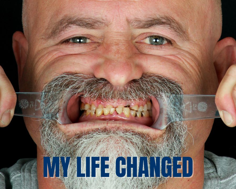 How Dental Implants Changed My Life in These 5 Ways